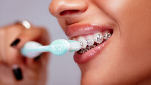 Should You Use an Electric Toothbrush With Braces