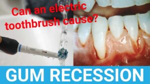 Can Electric Toothbrush Cause Gum Recession