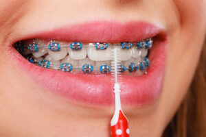 Are Electric Toothbrushes Better for Braces