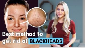 Can a Toothbrush Get Rid of Blackheads