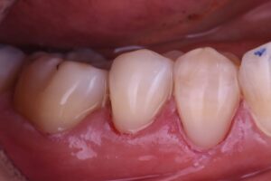 Can Toothbrush Abrasion Be Reversed
