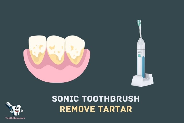 Can Sonic Toothbrush Remove Tartar