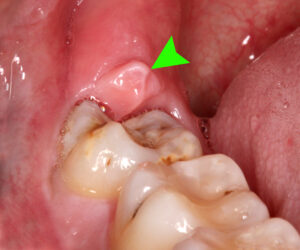 Abscess on Gum Where Wisdom Tooth Used to Be