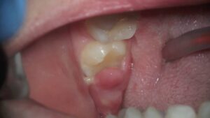 Blister on Gum Where Wisdom Tooth Should Be