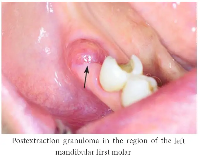 bubble-where-wisdom-tooth-was-removed