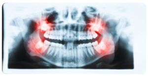 Can Braces Fix an Impacted Wisdom Tooth