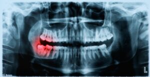 Can Covid Cause Wisdom Tooth Pain