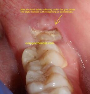 Can See White in Wisdom Tooth Hole