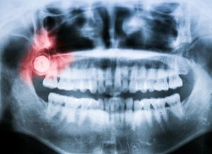 Can Wisdom Teeth Cause Front Tooth Pain