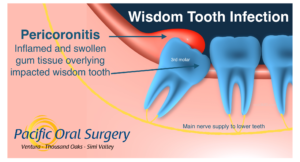 Can Wisdom Tooth Be Removed With Pericoronitis