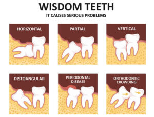 Can You Remove a Wisdom Tooth That Hasn’T Erupted