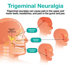Can a Wisdom Tooth Cause Trigeminal Neuralgia