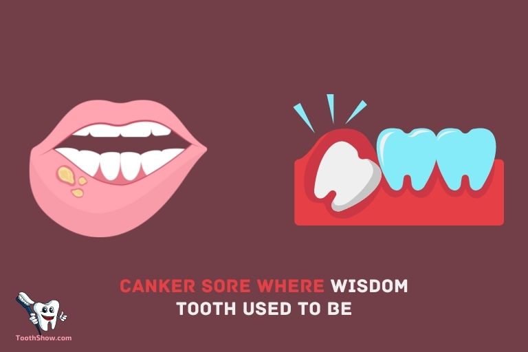 Canker Sore Where Wisdom Tooth Used To Be