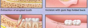 Cost of Wisdom Tooth Extraction in Canada