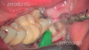 Cyst Where Wisdom Tooth was Removed