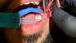 Difference between Wisdom Tooth Extraction And Surgery