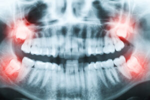 Different Types of Wisdom Tooth Extraction