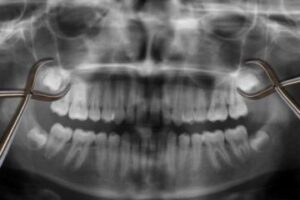 Does Medical Card Cover Wisdom Tooth Extraction