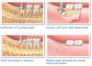 Does Nhs Cover Wisdom Tooth Removal