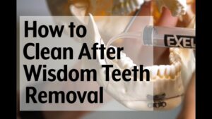 How Do You Clean Wisdom Tooth Extraction