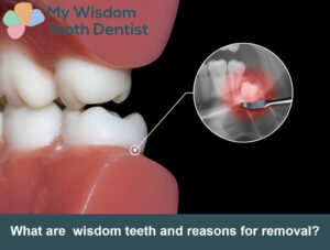 How Long to Eat Normally After Wisdom Tooth Extraction