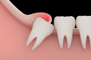 How Much Wisdom Tooth Extraction Cost in India