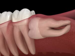 How to Know If Your Wisdom Tooth is Growing Sideways