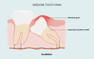 How to Numb a Wisdom Tooth Pain