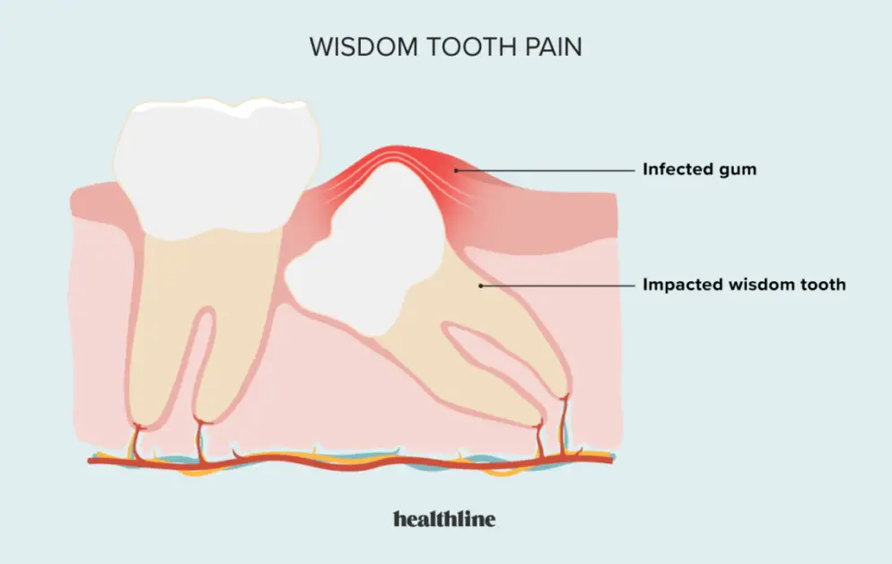 pain-where-wisdom-tooth-was-removed-years-later