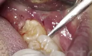 How to Pull a Broken Wisdom Tooth at Home