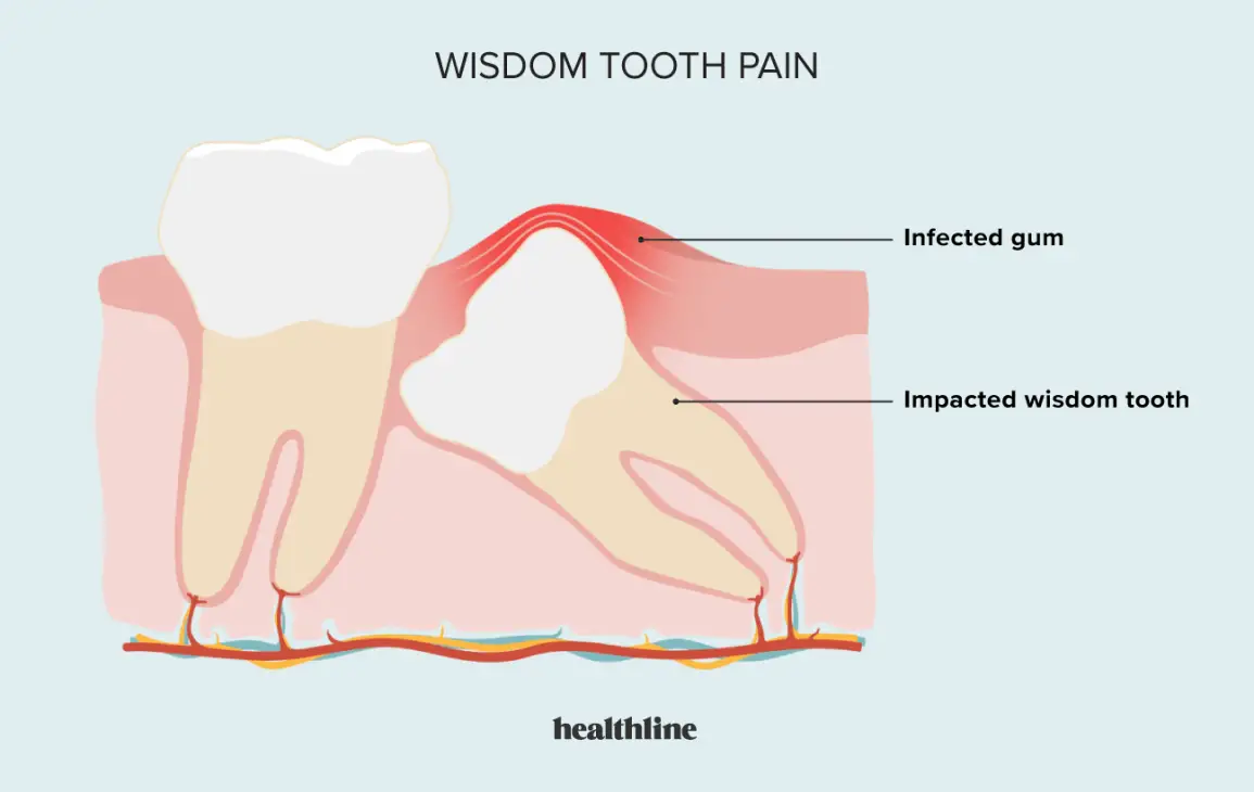 how-to-treat-swollen-gums-near-wisdom-tooth-while-pregnant