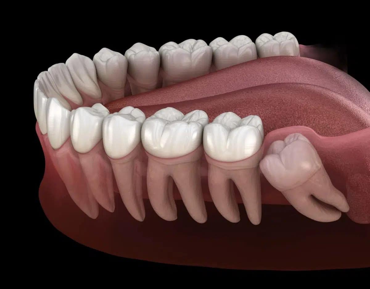 how-long-does-numbness-last-after-wisdom-teeth-removal