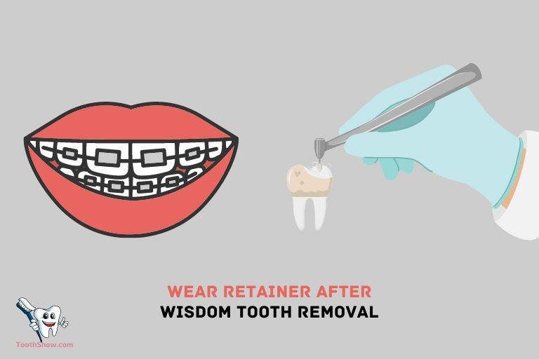Is It Ok To Wear Retainer After Wisdom Tooth Removal