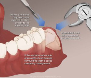 Is an Erupted Wisdom Tooth Easier to Remove