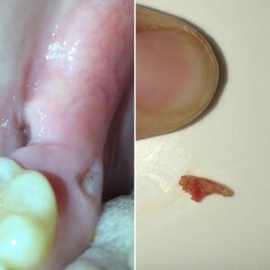 Pain Where Wisdom Tooth was Removed Months Later