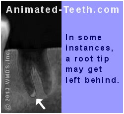 Root Tip Left After Wisdom Tooth Extraction