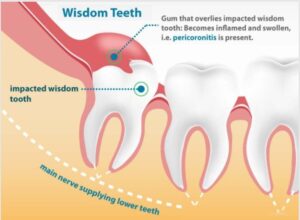Severe Pain in Wisdom Tooth Area