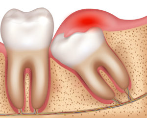 What Does a Wisdom Tooth Cyst Look Like