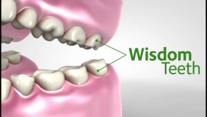 What Does a Wisdom Tooth Mean