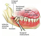 What Happens If Wisdom Tooth Hits Nerve