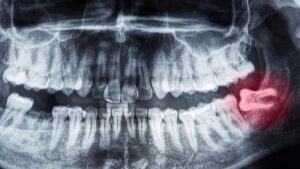 What Happens If You Leave a Wisdom Tooth in
