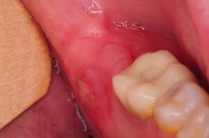 What Happens to Gums After Wisdom Tooth Extraction