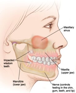 What is Wisdom Tooth in Tagalog