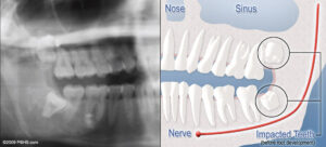 What is a Bony Impacted Wisdom Tooth