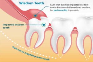 What is a Simple Wisdom Tooth Extraction