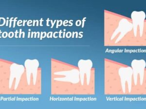 What to Expect 4 Days After Wisdom Tooth Extraction
