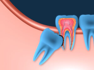 What to Expect 48 Hours After Wisdom Tooth Extraction