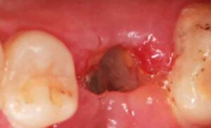 When Does Granulation Tissue Form After Wisdom Tooth Extraction