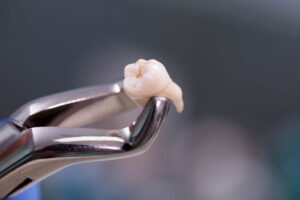 When to See Dentist After Wisdom Tooth Extraction