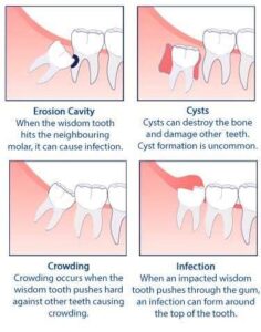 When was the First Wisdom Tooth Extraction